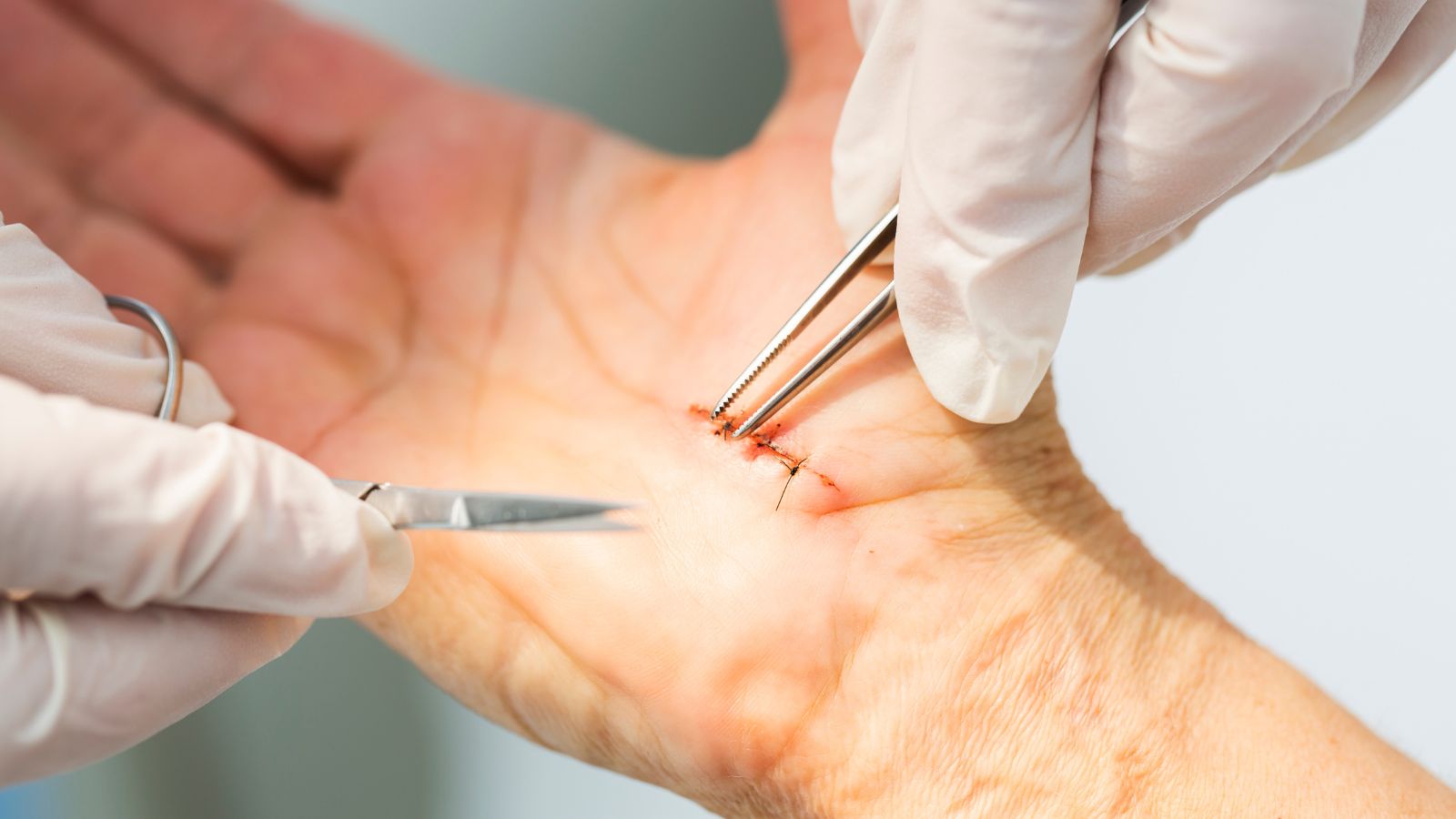 ¿Por qué reaparece el síndrome del túnel carpiano tras una cirugía?