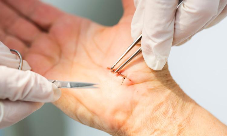 ¿Por qué reaparece el síndrome del túnel carpiano tras una cirugía?